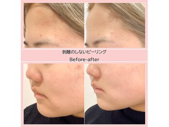 ディアメ(Diame)/ピーリングでニキビケア☆