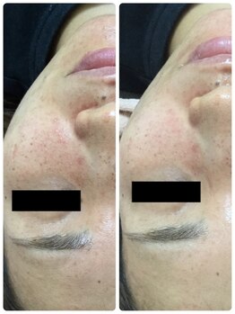 メイユール(MEILLEUR)/光フェイシャル1回