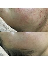 エヌエー(na)/毛穴トラブル・ニキビケア