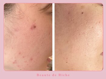 ボーテドリッシュ(Beaute de Riche)/ニキビケアbeforeafter