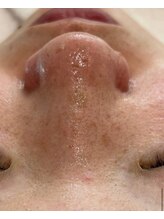 ルチル(Rutile)/韓国式3D毛穴洗浄