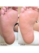 ザ ヴォーグ(the VOGUE)/足裏角質ケア　ペディネット