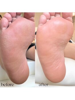 ザ ヴォーグ(the VOGUE)/足裏角質ケア　ペディネット