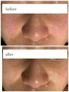 アロマ&クレイケアルーム ネロリドール(Nerolidol)/毛穴汚れもスッキリ♪