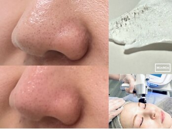 ジルフィー(GILFY)の写真/小鼻の黒ずみ…実は毛が原因かも?!フェイシャルワックス脱毛×エクソリフトで肌負担を少なくうる艶肌を☆