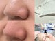 ジルフィー(GILFY)の写真/小鼻の黒ずみ…実は毛が原因かも?!フェイシャルワックス脱毛×エクソリフトで肌負担を少なくうる艶肌を☆