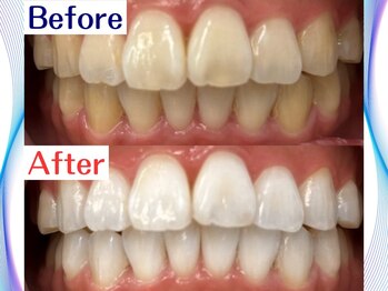 LBSホワイトニング 新宿店/ホワイトニングビフォーアフター