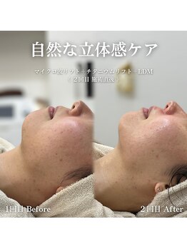 イロハ(IROHA)/2回の施術効果◎