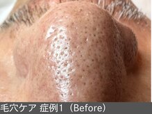 オアシスラグーン(OASIS LAGOON)/毛穴ケア（症例1 before）