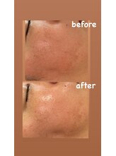 ヒーリングサロン イチマルイチ(101)/スノーピーリング＆シミ改善ケア