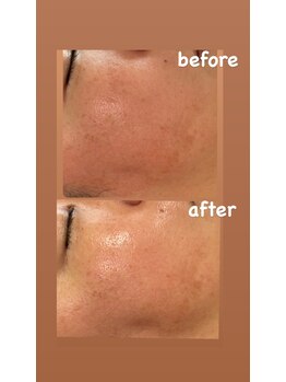 ヒーリングサロン イチマルイチ(101)/スノーピーリング&シミ改善ケア