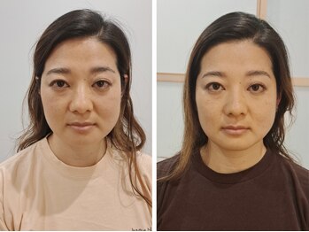 バーンノーク(baan Nook)の写真/首・肩こり・頭痛改善から生まれた小顔矯正の技術♪顔の骨格調整で頭痛や目の疲れを軽減し、リフトアップ◎