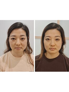 小顔になりたい