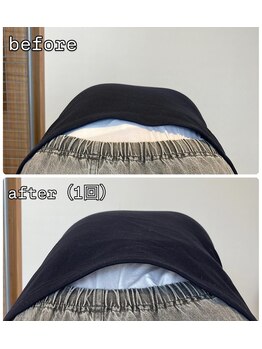 小顔22 ボルティ 赤坂支店(Bolty)/【悩み】脊椎側湾症