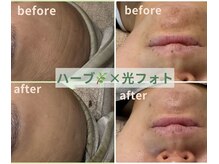 サンテ(Sante)の雰囲気（ハーブ×光フォトでおでこの横じわアゴのザラつきが改善）