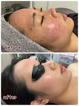 ケースタイル(k.style)/アクネケア