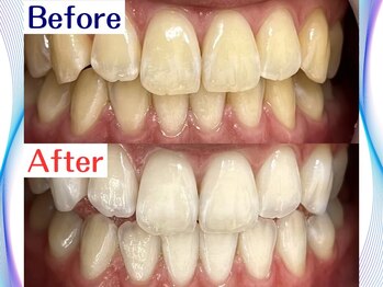 LBSホワイトニング 新宿店/ホワイトニングビフォーアフター