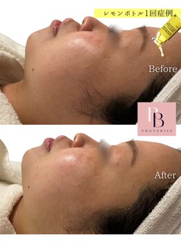 フォトビズ/たるみもたつき二重あご改善