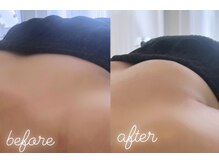 エムプリュ 心斎橋店(M.plus)/脂肪培養プレミアムコース1回目