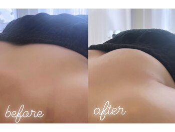 エムプリュ 心斎橋店(M.plus)/脂肪培養プレミアムコース1回目