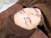 美リレア/大人気☆美容鍼