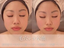 R-1ビューティーサロン 表参道/お得★毛穴レス小顔