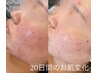 7月限定★《年齢肌向け!!結果に自信》シミシワ改善ハーブピーリング(DT無）