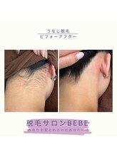ベベ(Bebe)/うなじ脱毛♪