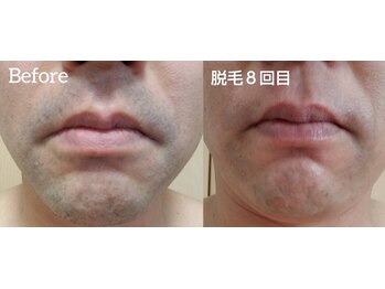 イズム(ism)/脱毛◆３回目 ⇒ ８回目◆