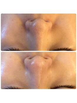 エステサロンブランシュ(Esthe salon Blanche)/ハーブピーリングで毛穴ケア