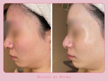 ボーテドリッシュ(Beaute de Riche)/美白フェイシャルbeforeafter