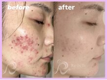 ビューティルーム アム(BEAUTY ROOM amu)/Rebelleハーブピーリング