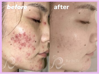 ビューティルーム アム(BEAUTY ROOM amu)/Rebelleハーブピーリング