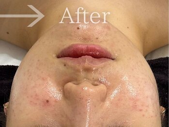 フェイシャルヴィム(FACIAL VIM)/ハーブでニキビケア＆肌質改善