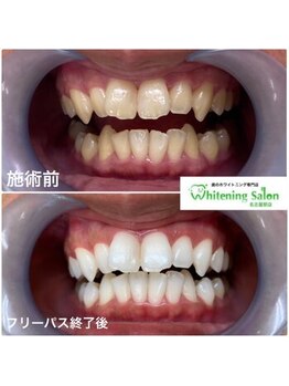 ホワイトニングサロン 名古屋駅店/【ホワイトニング施術例】