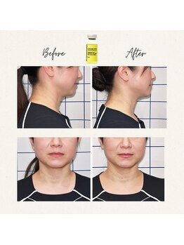 鍼灸院 満月/レモンボトルで脂肪分解