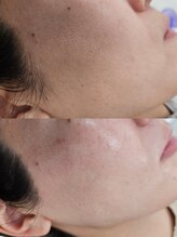 アール(R)/フェイシャルwax&光フェイシャル