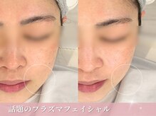 話題のプラズマフェイシャルでお肌の悩みを根本改善◎