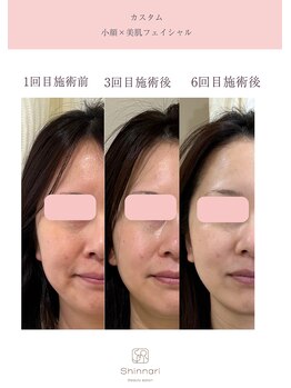 シンナリ(Shinnari)/カスタム小顔×美肌フェイシャル