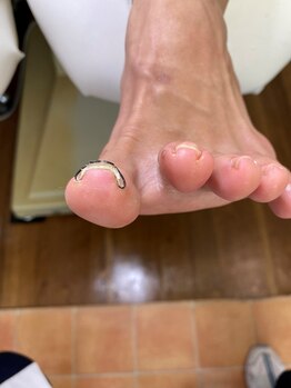 巻き爪矯正 ツメフラ法