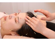 ハリプラス(HariPlus)/美容鍼施術の様子[ヘッドスパ]