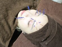 美リレア/大人気☆美容鍼