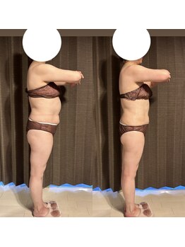 カシェット(cachette)/ウルトランスフォーマー痩身