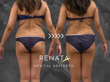 レナータ 渋谷店(RENATA)/ 【脂肪冷却】2ヵ月通い放題