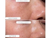 ルソール 銀座(Le seul)/エクソソーム　シミケア