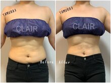 クレール(CLAIR)/痩身マシンTAMURA3