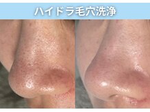 BUB 立川/黒ずみ、くすみオフ