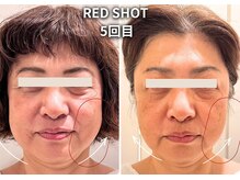 エトワール(etoile)/レッドショット/小顔・天王寺