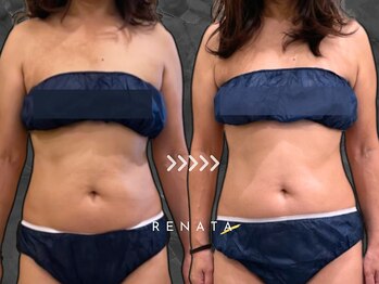 レナータ 渋谷店(RENATA)/【脂肪冷却】８カップ×５回