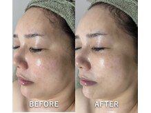 サロンドジェシカ(salon de Jessica)/プラズマ＋フォト美顔